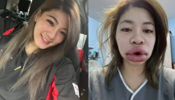 Женщина из Бангкока рассказывает поучительную историю об инъекциях филлеров