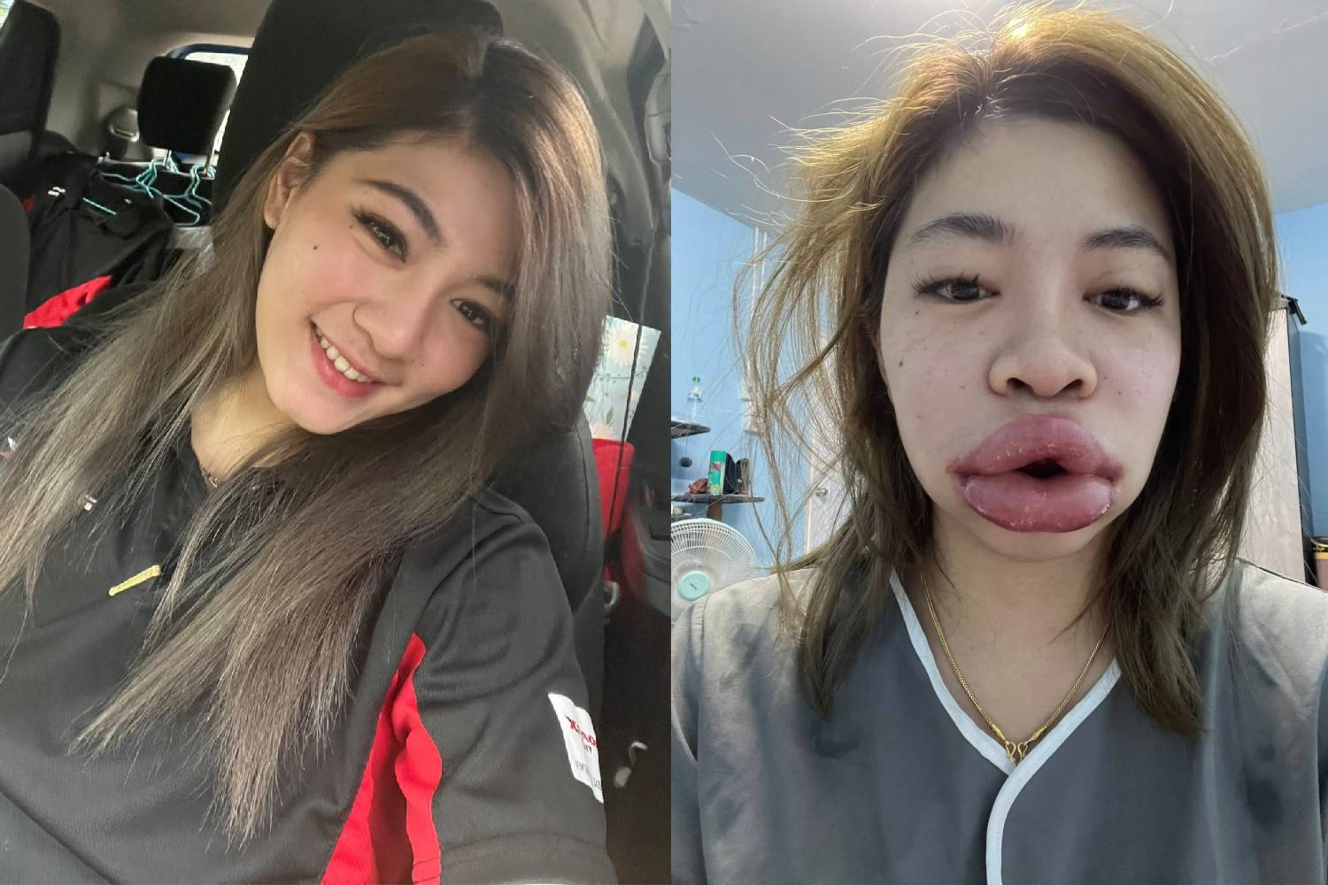 Женщина из Бангкока рассказывает поучительную историю об инъекциях филлеров