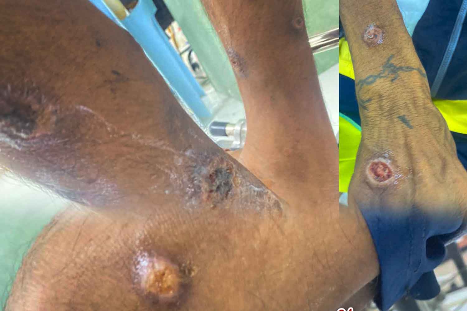 Любитель сырой говядины - последний случай сибирской язвы