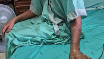 Тайский продавец чуть не умер после лечения опоясывающего лишая народным средством