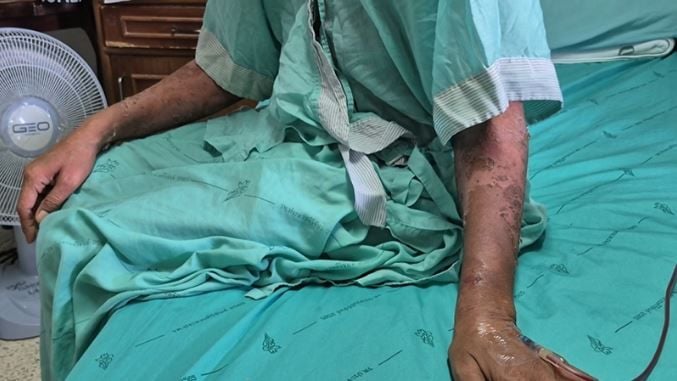 Тайский продавец чуть не умер после лечения опоясывающего лишая народным средством