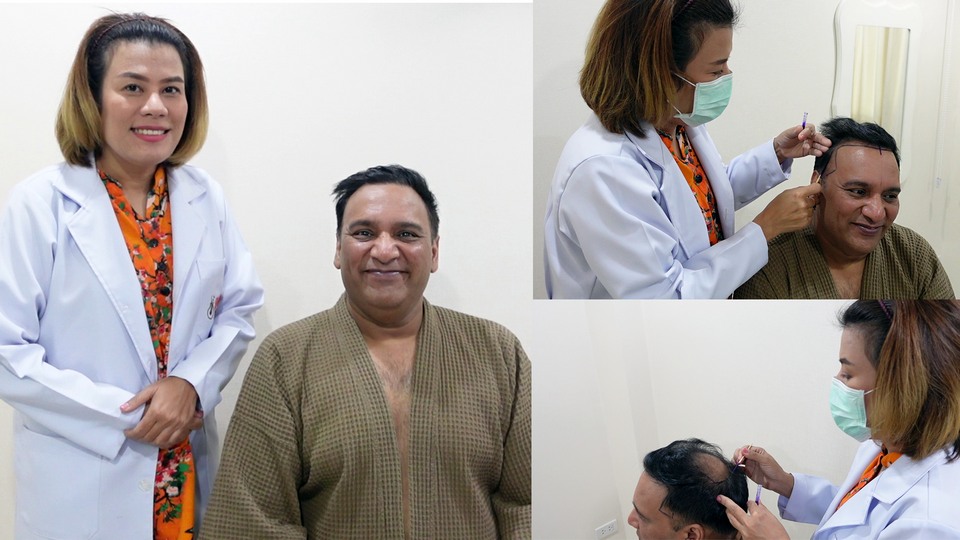 Пересадка волос в Бангкоке при потере волос и облысении