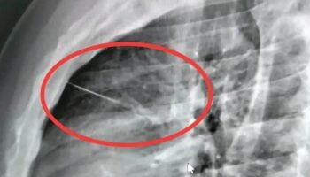 Бурира́мец нашёл иглу длиной 7 сантиметров рядом с сердцем после травмы груди