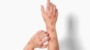 Сотрудники здравоохранения предупреждают группы высокого риска о mpox